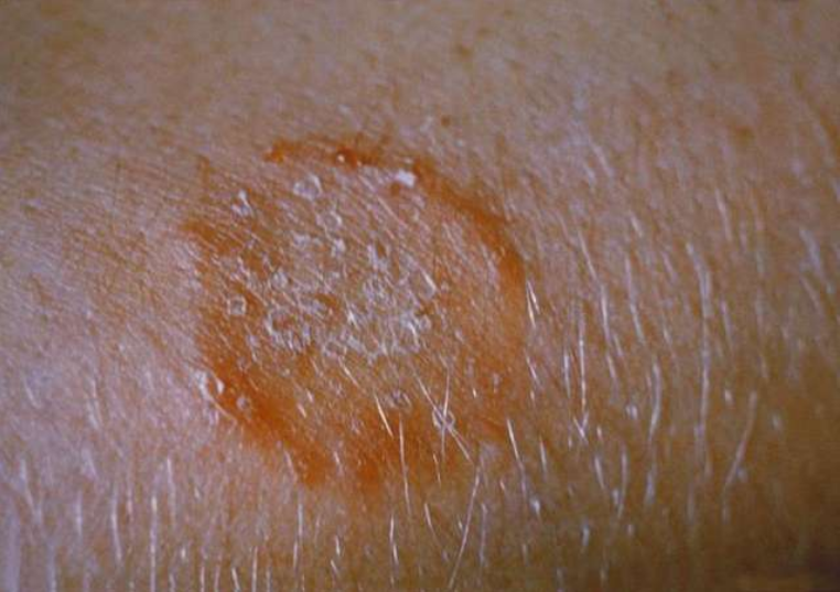 القوباء الحلقية